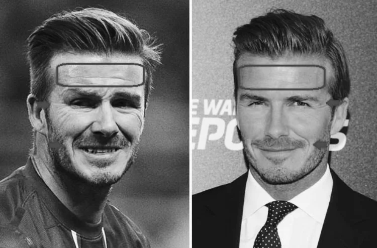 botox preston for men