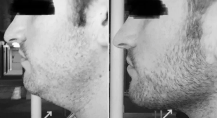 jaw fillers for men preston