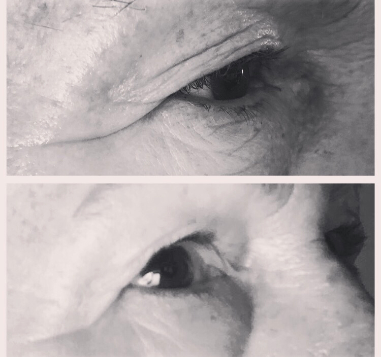 Plasma BT elderly woman eye.jpg