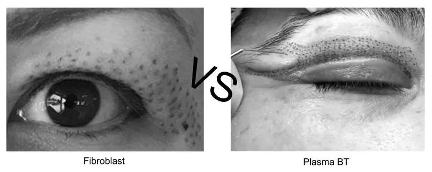 plasma bt vs fibroblast.jpg