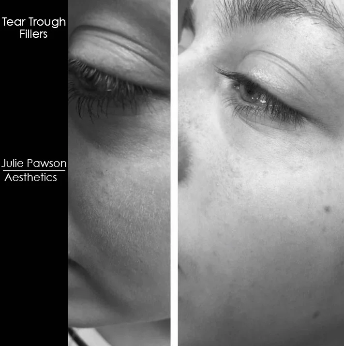 tear trough fillers final.jpg