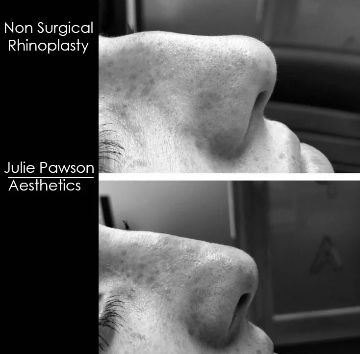 nose job final.jpg