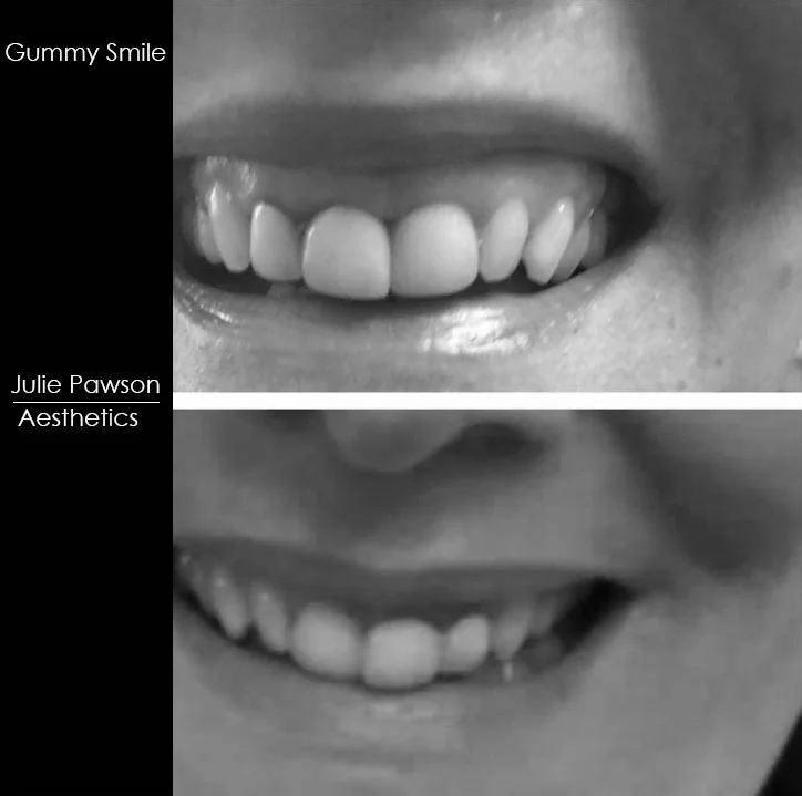 Gummy Smile .jpg