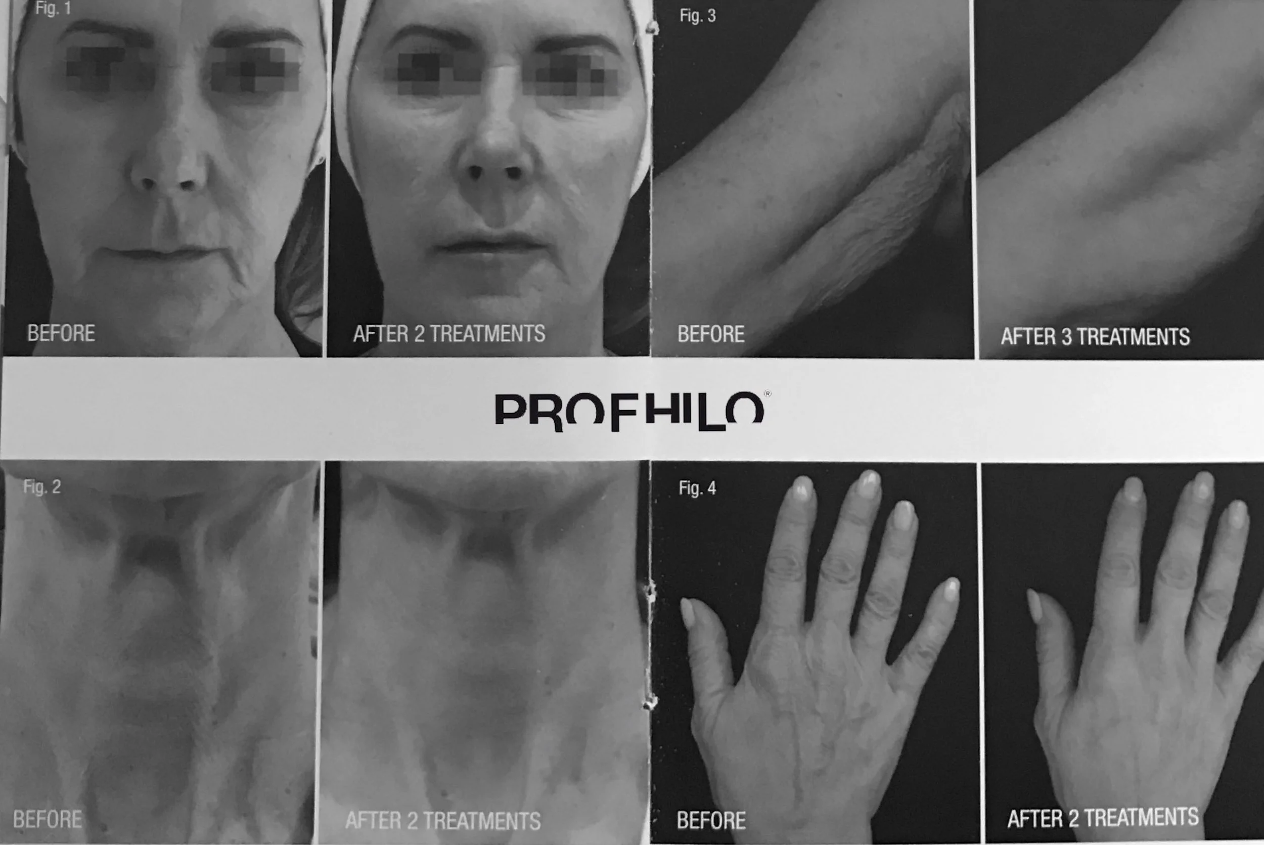 profhilo results final.jpg