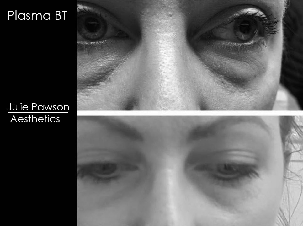 graves disease plasma bt.JPG