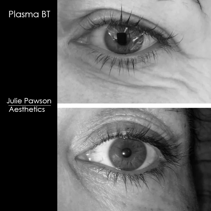 upper lid plasma BT.jpg