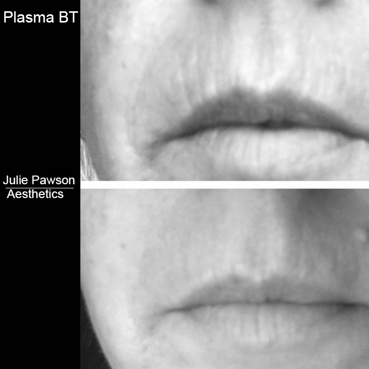 plasma bt smokers lines 2.jpg