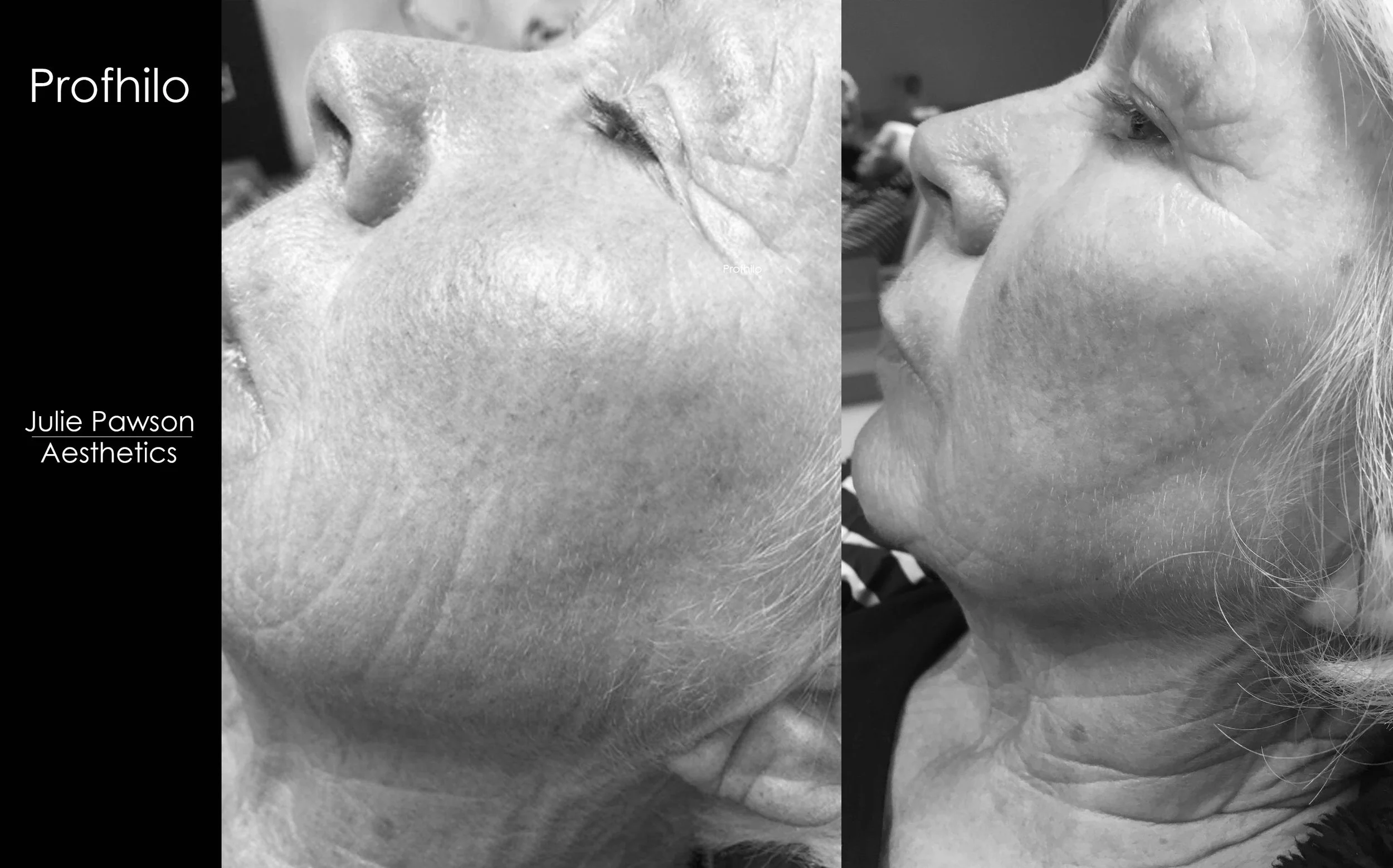 profhilo result copy.jpg