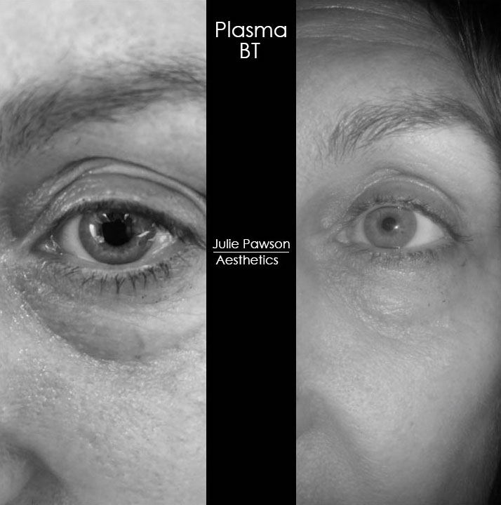 2 sessions of Plasma BT eye.jpg