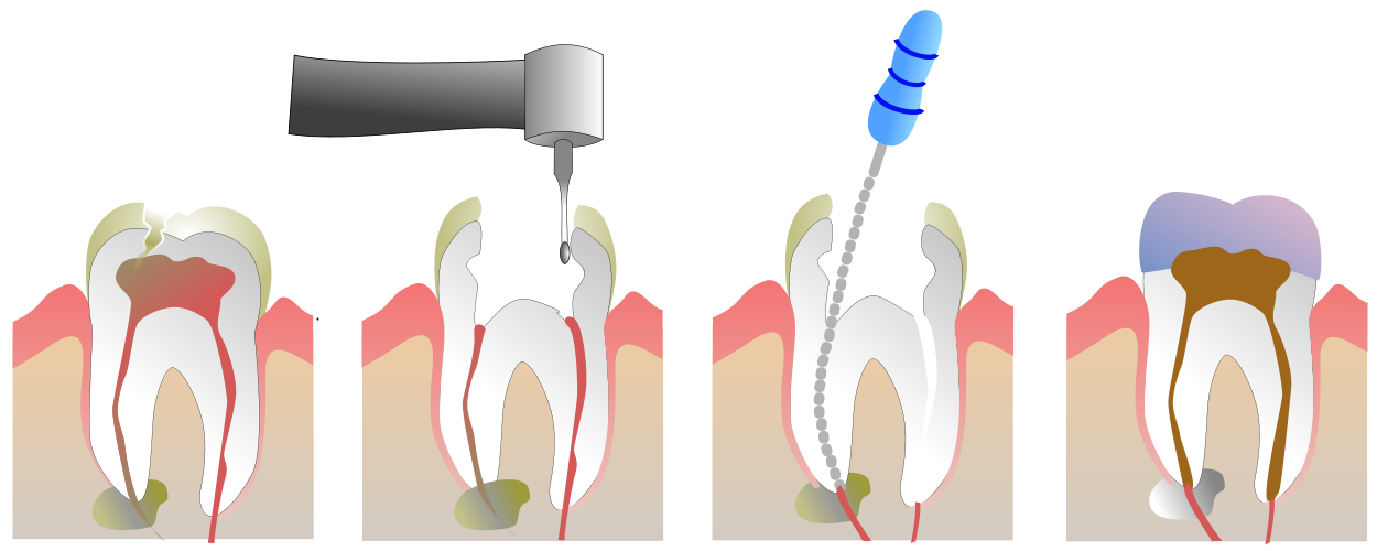 Chico Dentist Root Canal.png