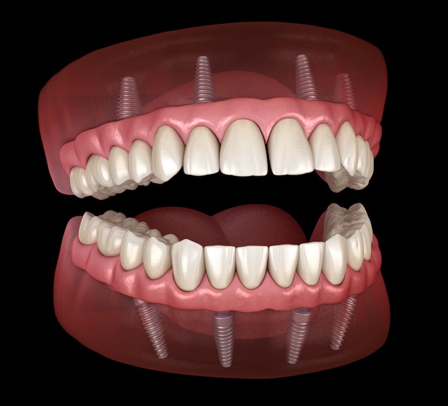 Implant-Supported Dentures vs. Traditional Dentures: Which Is Best in Chico?