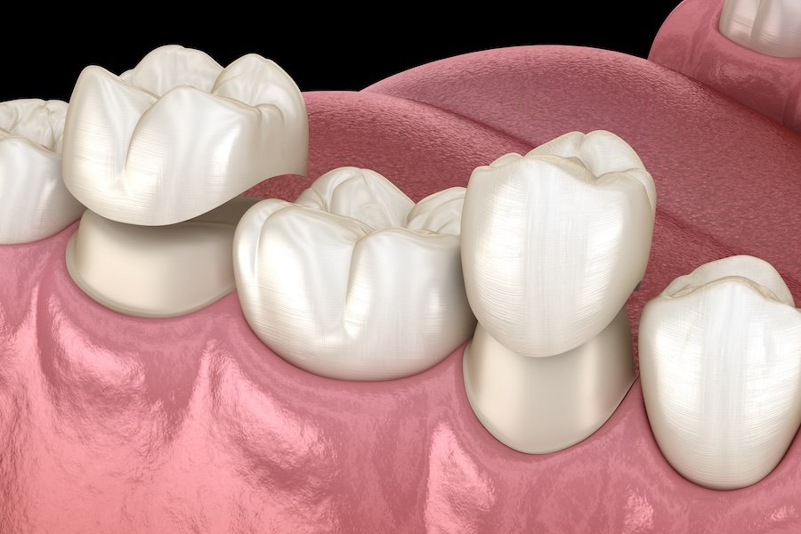 Same-Day CEREC Crowns in Chico: When One-Visit Dentistry Makes Sense