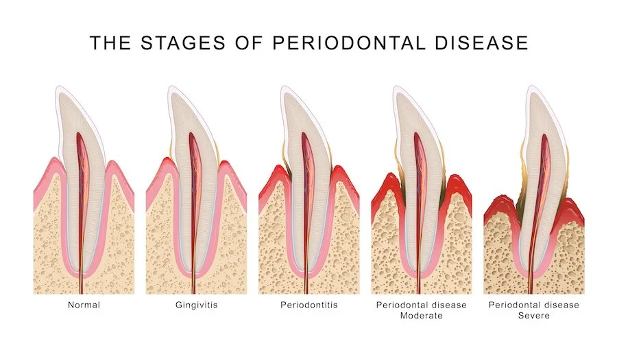Bleeding Gums or Bad Breath? When Periodontal Care Can Help Protect Your Smile