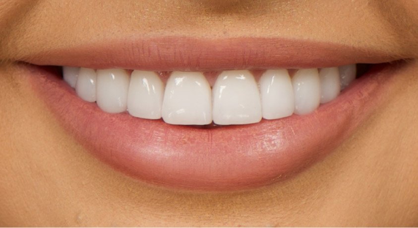 How Can Veneers Enhance Both Smile Aesthetics and Dental Health?
