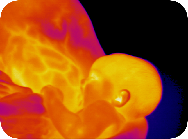 RADIANT BODY THERMOGRAPHY