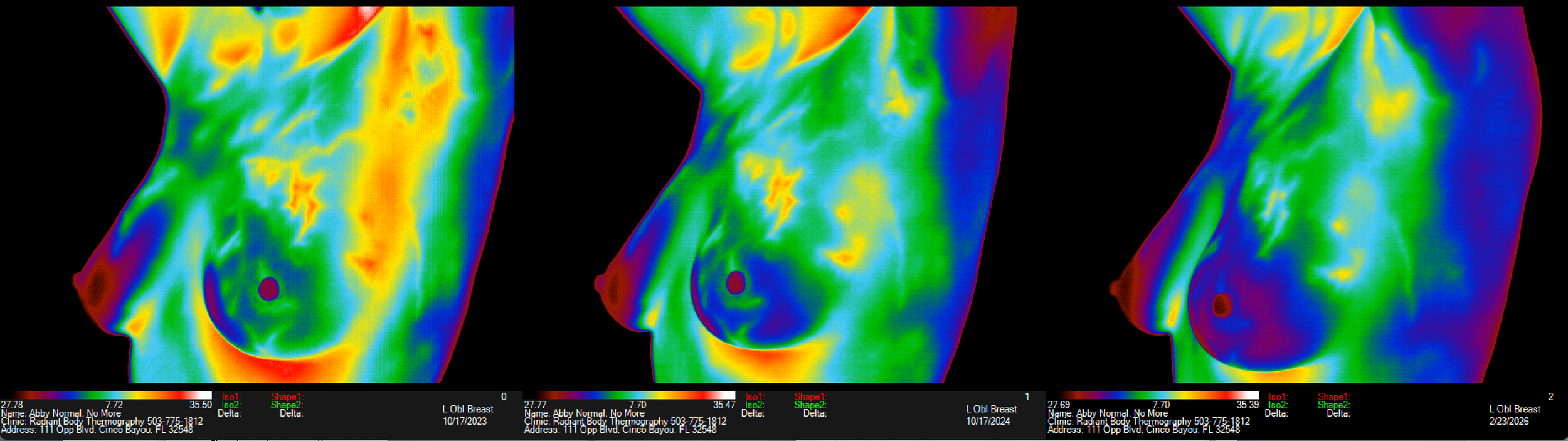 ABNORMAL Left Breast REVERSED Plus "Significant Improvement" in the Estrogen Pattern!!!