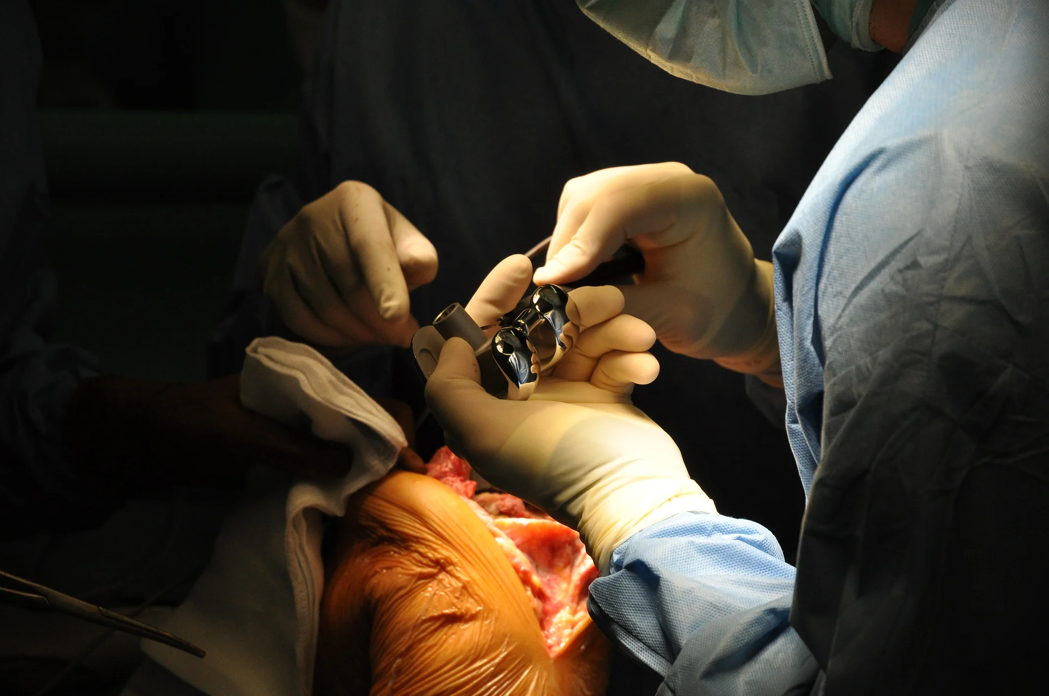 Knee replacement 3.jpg