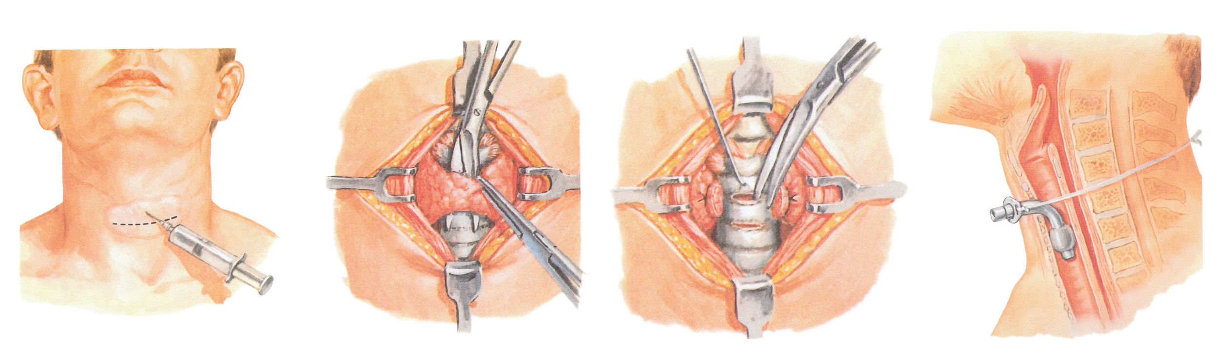 Netter, F. H. (1975). Tracheotomy surgery illustrations. The CIBA Collection of Medical Illustrations: Respiratory system: Elsevier Science Health Science div.