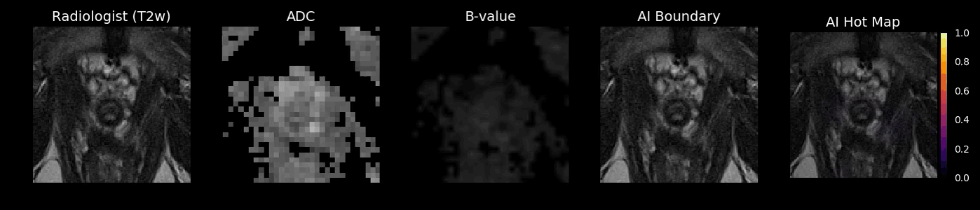 Radiologist vs AI detection of cancer in MRI scans (Courtesy Ezra)