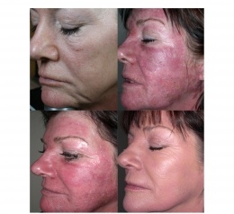 Post Laser Treatment - 3 LIGHTWAVE (Red/IR Combo) Sessions over 1 week