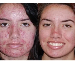12 LIGHTWAVE (Red/Blue) Sessions over 4 weeks - Active Acne LIGHTWAVE (Red/IR) Sessions over 4 weeks - Scarring/Discoloration 3 Pro Peels