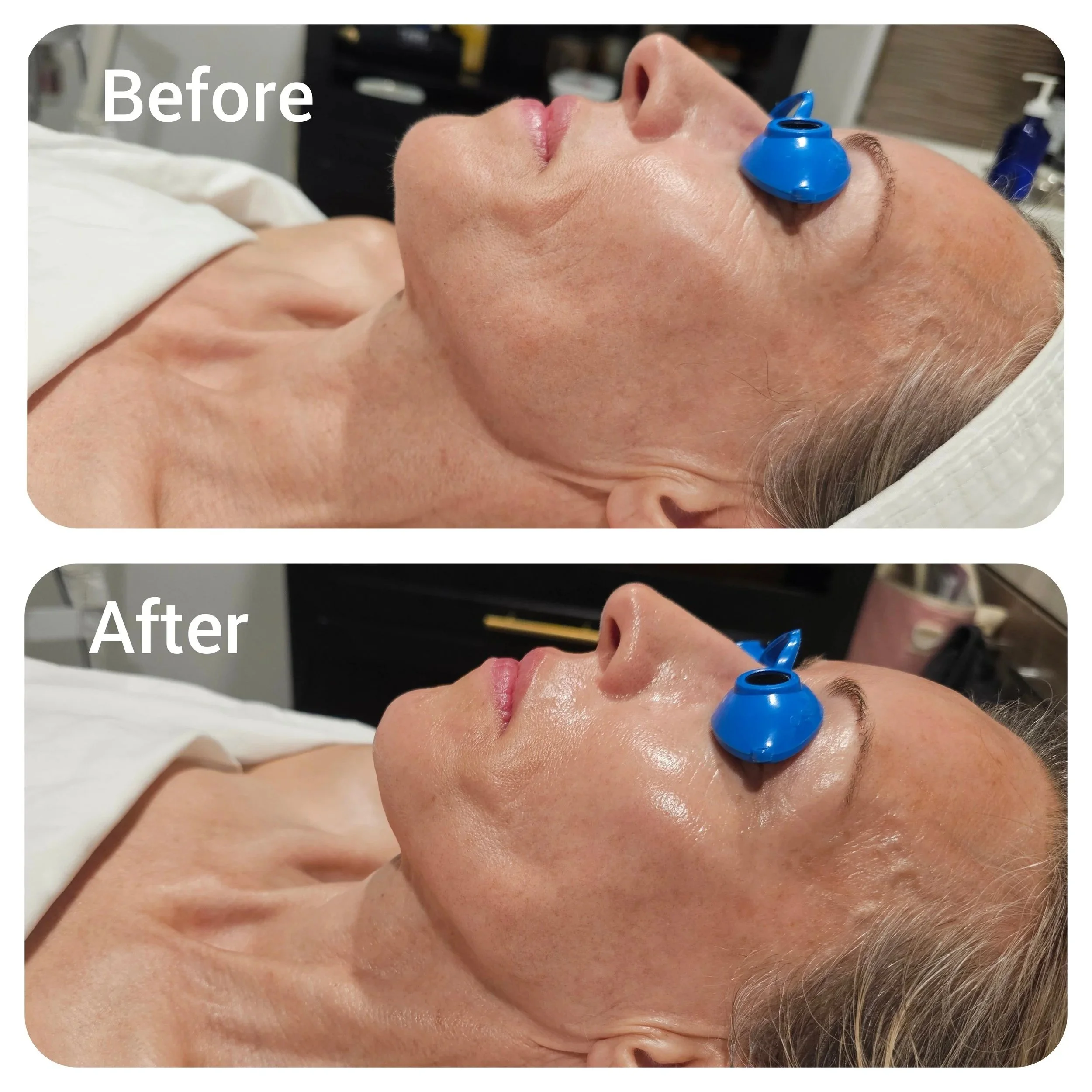 Before and After a Custom Facial
