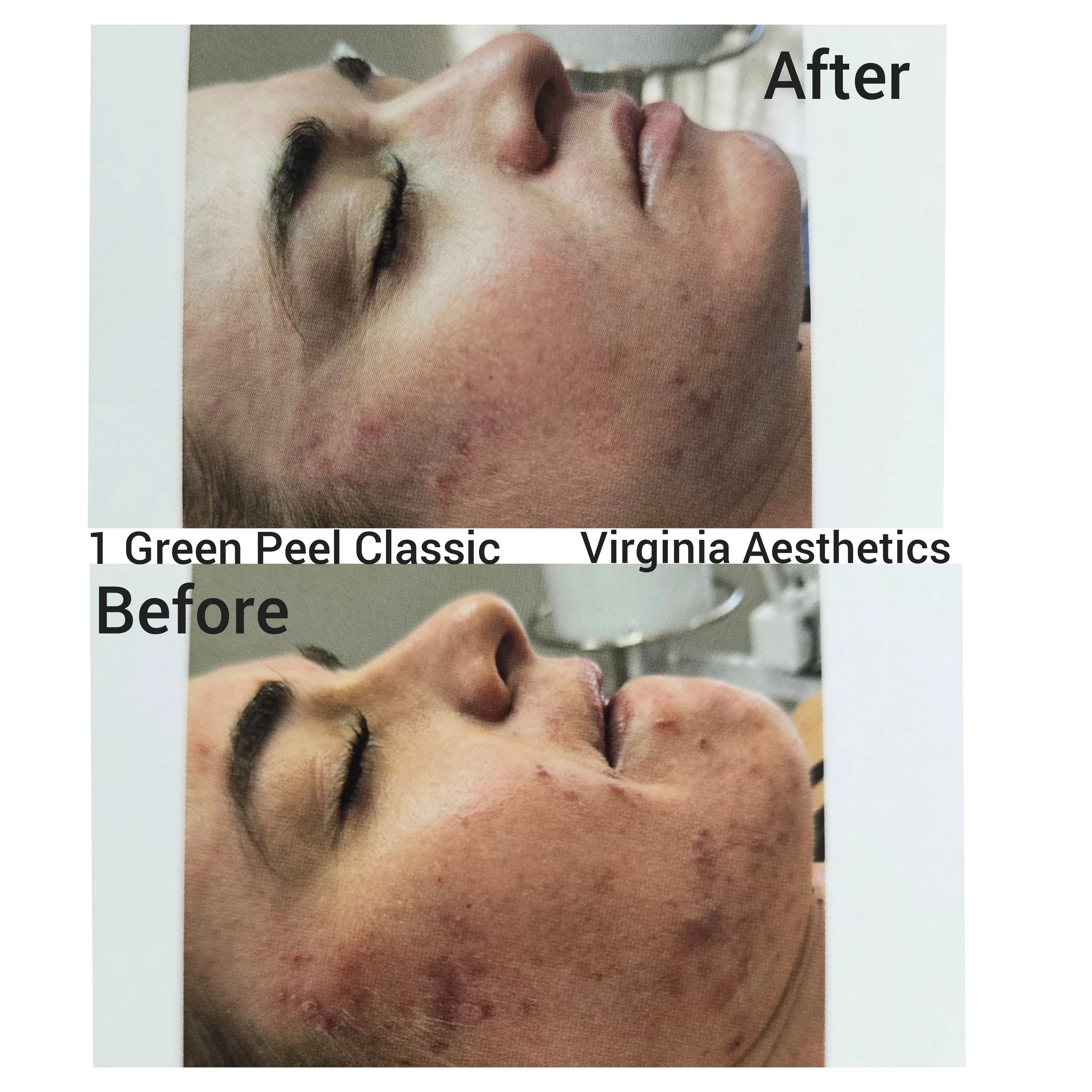 Green Peel Results Acne and Scar Reduction