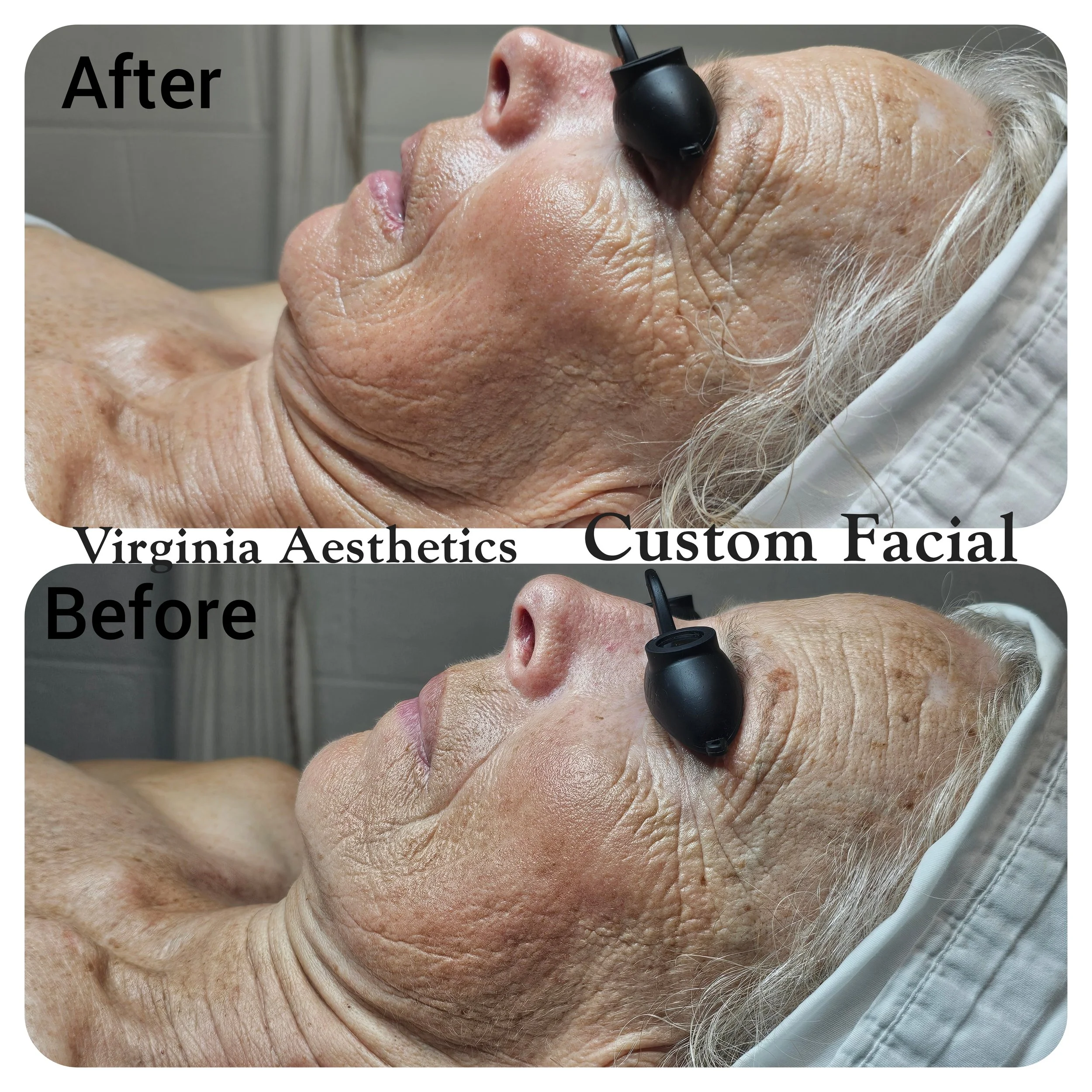 Custom Facial Results