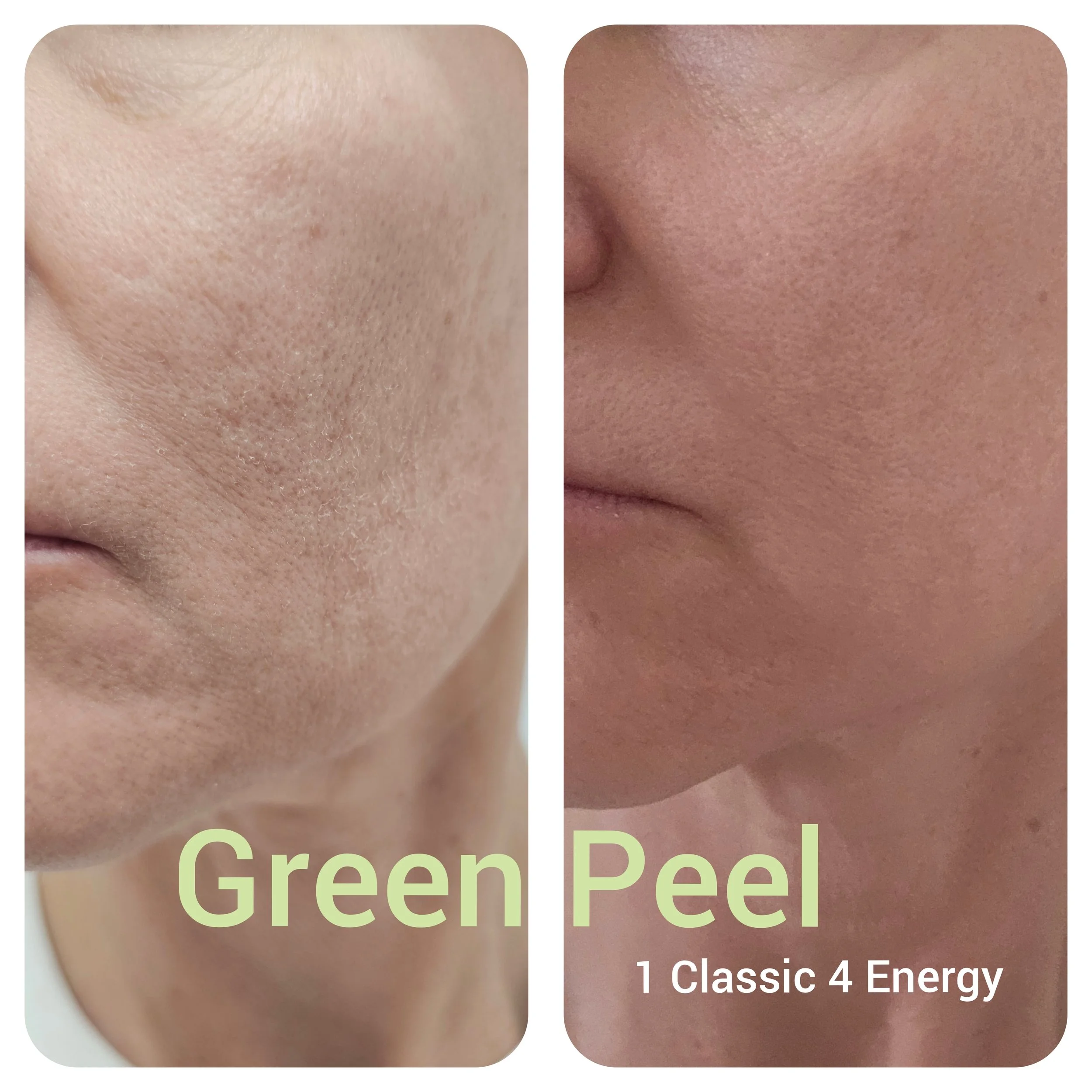 Green Peel Scar Reduction Skin Tightening