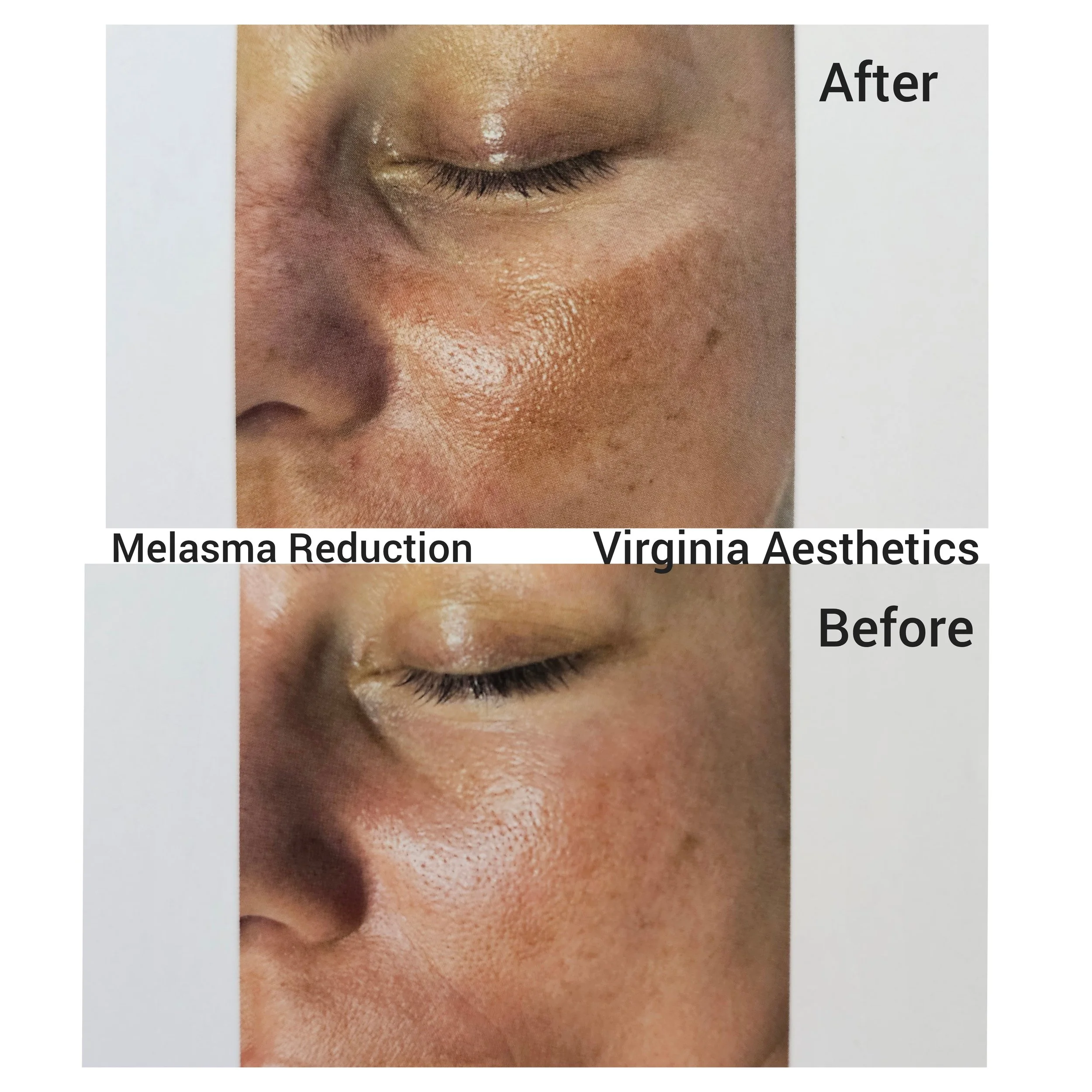 Green Peel Results for Melasma Reduction