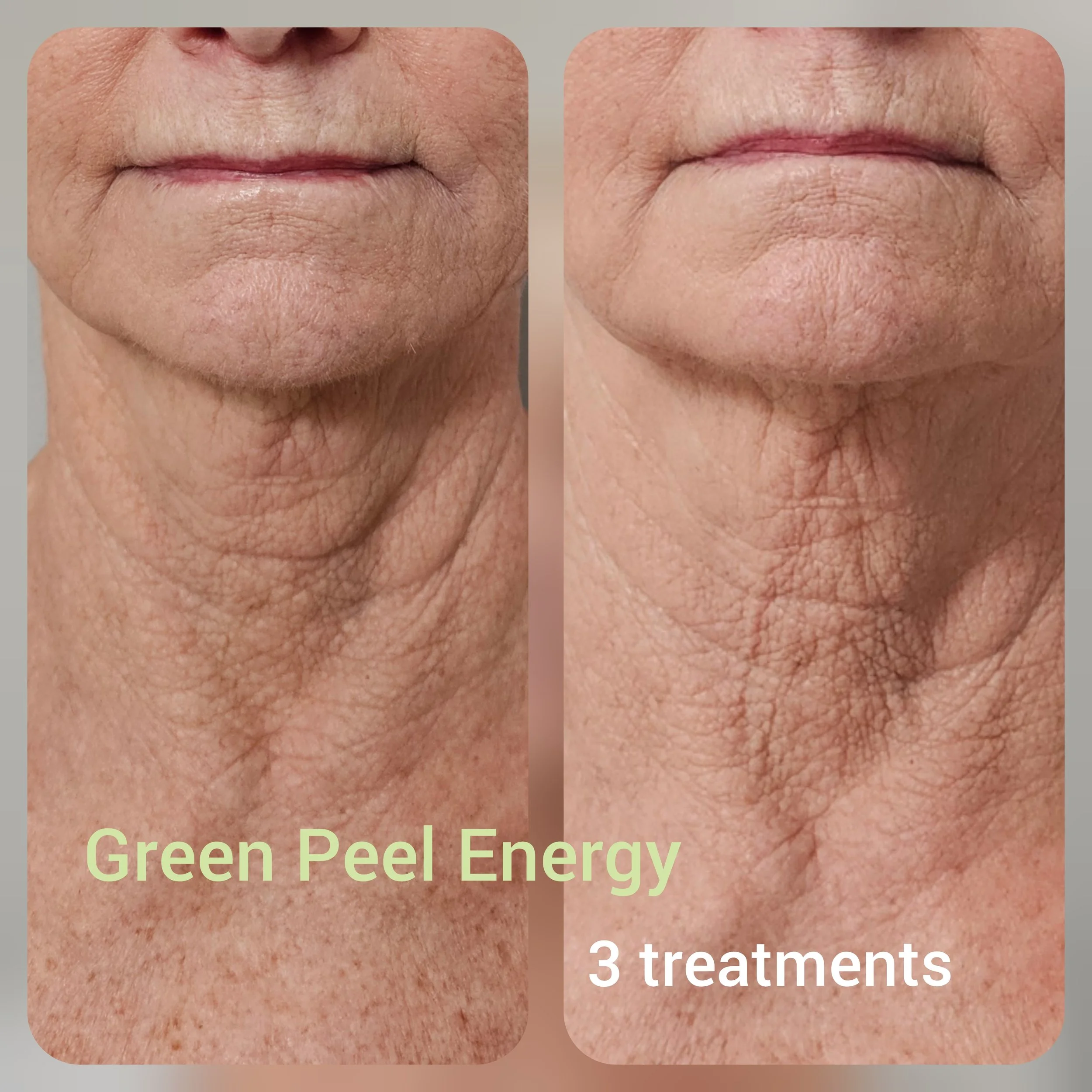 Green Peel  Skin Tightening