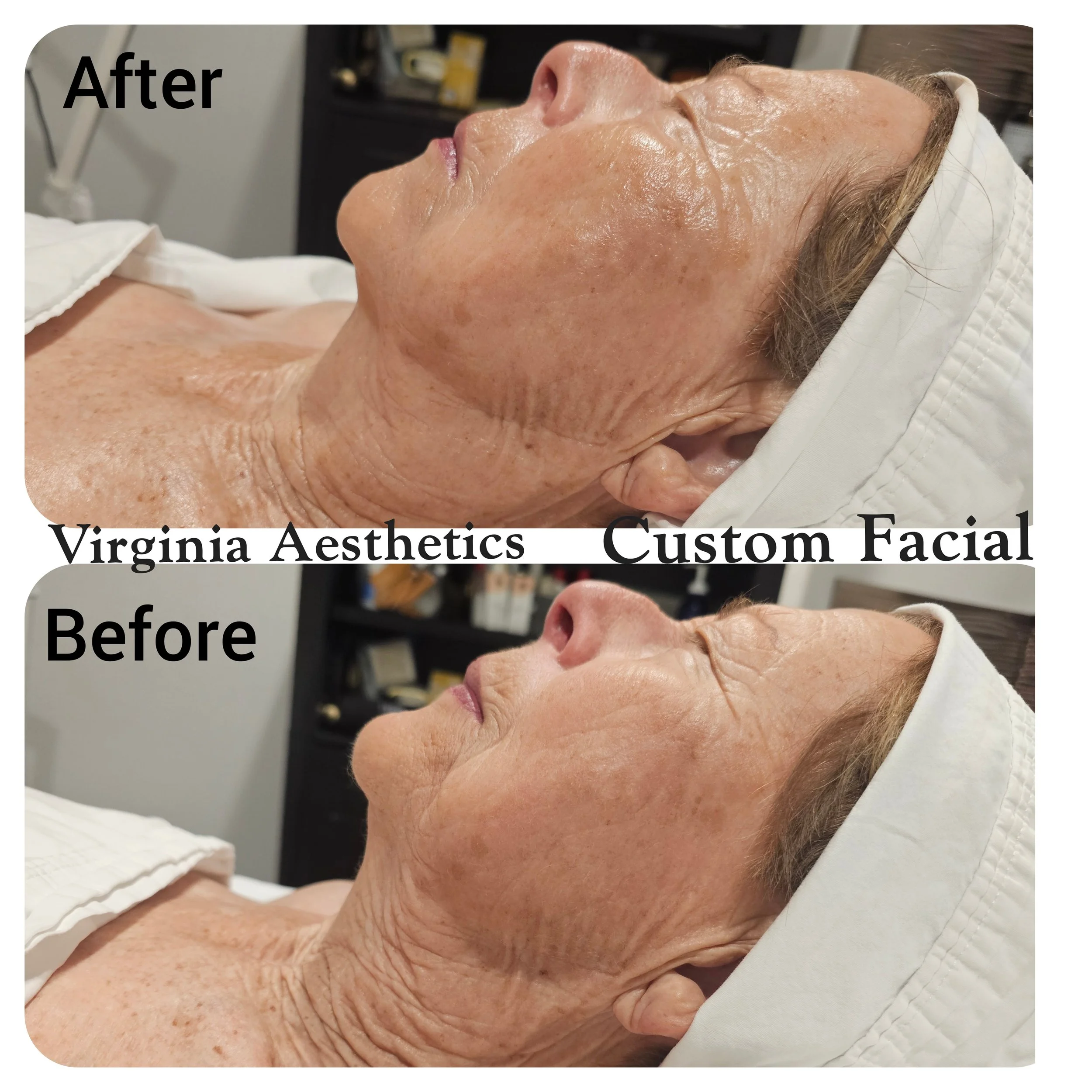 Custom Facial Results