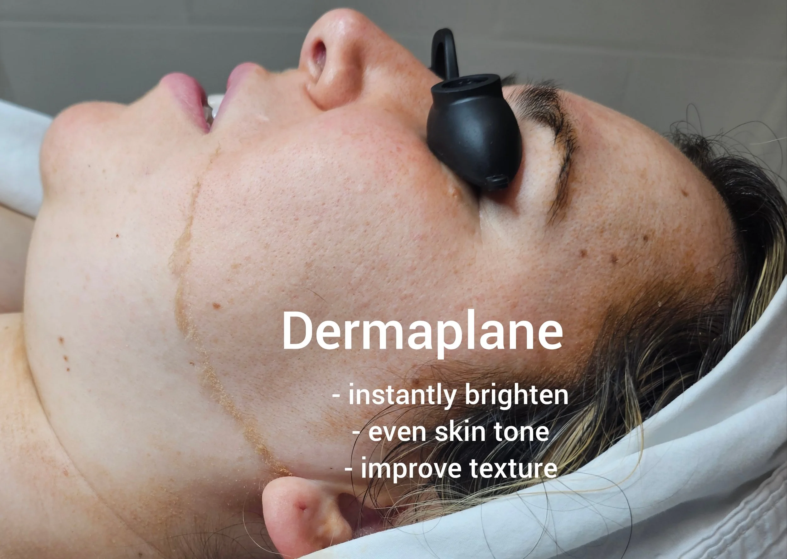 Dermaplane Treatments results