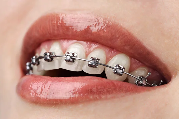 Orthodontic Braces STAR dentistry.jpg