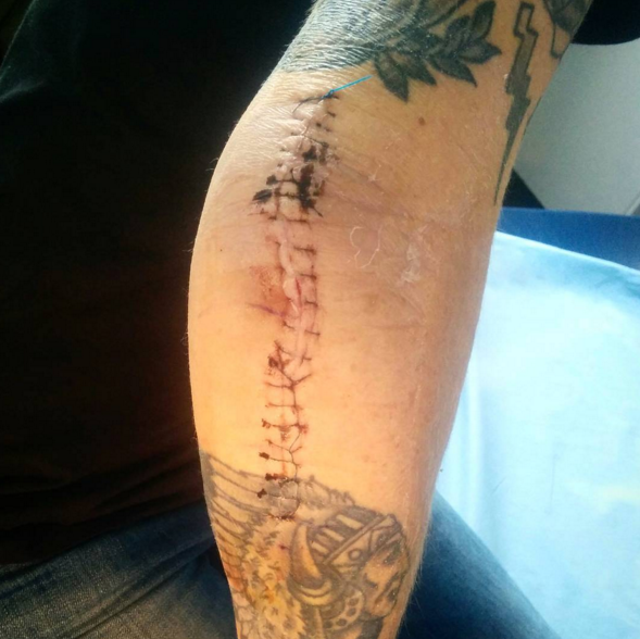 Having my cast off was awful. No one told me I wouldn't be able to move my arm. It was such a shock I had to put my head between my knees!
