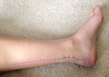  Scar at eight weeks post-op