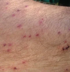 About 20 bites per square inch all over my arms and back during a day of trout fishing