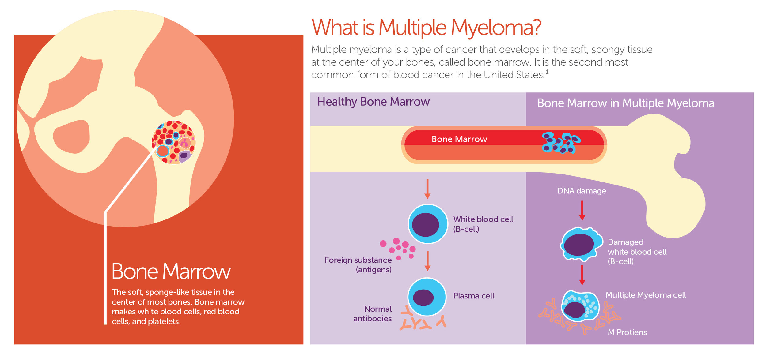 Myeloma diagram1.jpg
