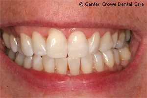 bleaching_patienth_after.jpg