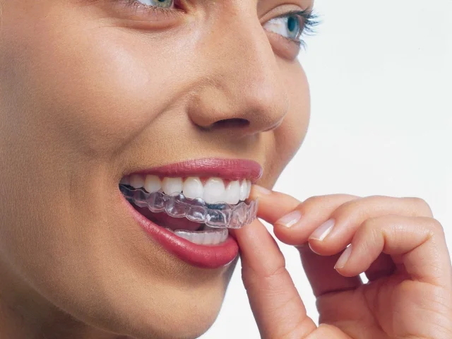 Clear Braces (Invisalign) - Want to discreetly improve your smile? This is the ultimate in terms of esthetic treatment. Custom molded clear trays are tailored to your specific needs to move your teeth to their ideal positions. Because of they are removable, patient compliance is extremely important to achieve desired results. 