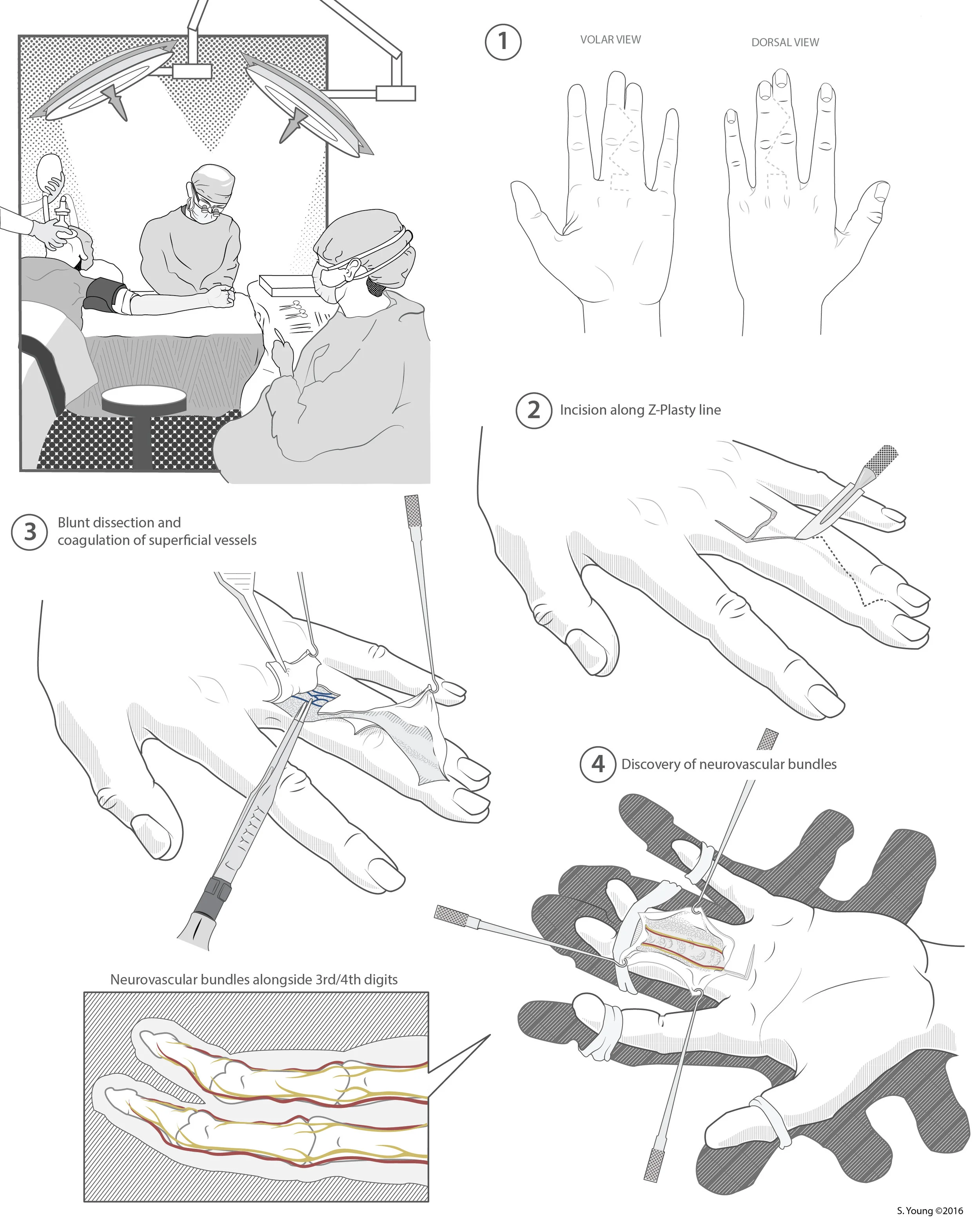 SyndactylySurgeryFINAL-01.jpg