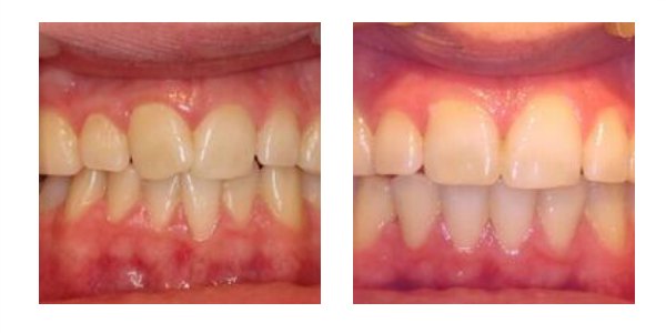 Case 2 This young man was unhappy with the way the front teeth were overlapping and crossed over. QST fixed braces were worn for seven months to align the teeth. He Is now proud of his smile and wishes he had done it sooner!