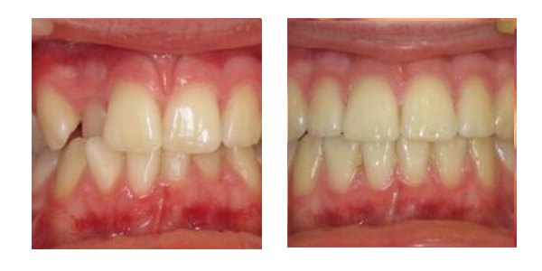 Case 1 This lady was particularly unhappy with the upper tooth that was stuck on the inside and the general crowding of her front teeth. She had a QST fixed brace for 6 months and she loves the result!