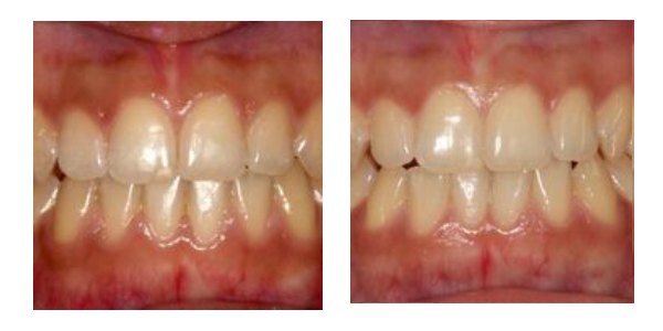 Case 4 This lady in her late 20s had worn braces as a teenager but was not given a retainer to keep them straight. Consequently her teeth had moved again. She wore a QST brace for five months to realign her teeth. She now has fixed and removable retainers to prevent any further movement.