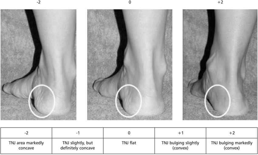 the-evaluation-of-bulging-in-the-region-of-the-talonavicular-joint.png