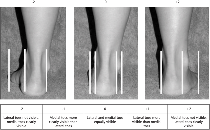 The-evaluation-of-the-abduction-adduction-of-the-forefoot-on-the-rear-foot.png