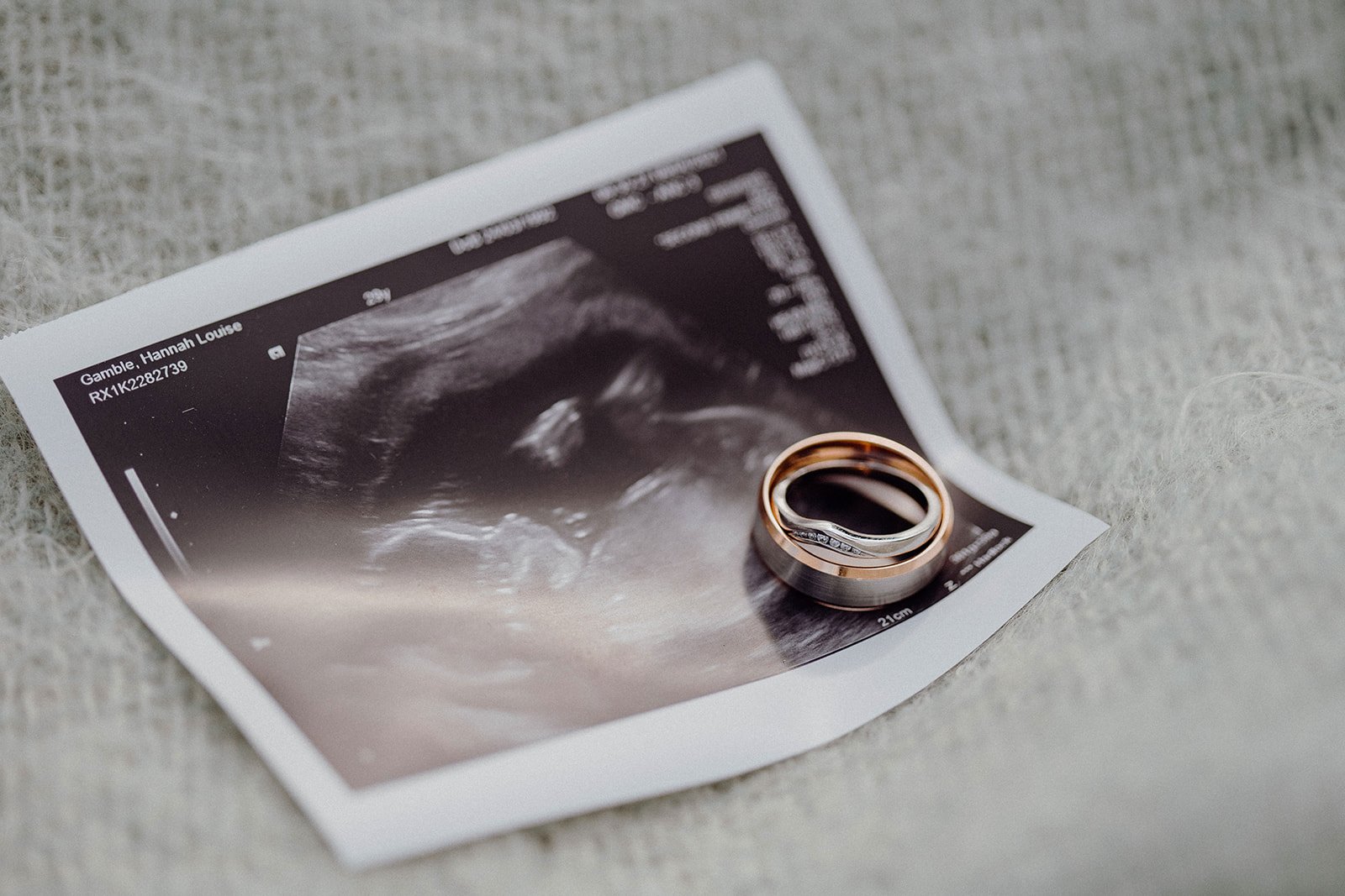 wedding rings on ultrasound 