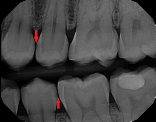 This X-ray shows decay (the dark areas on the teeth), which often starts between the teeth at the contact where bacteria can hide from brushing. To the right of the top arrow is a cavity. To the left of the bottom arrow is a smaller area of tooth decay that may be maintainable and may not need a filling yet.