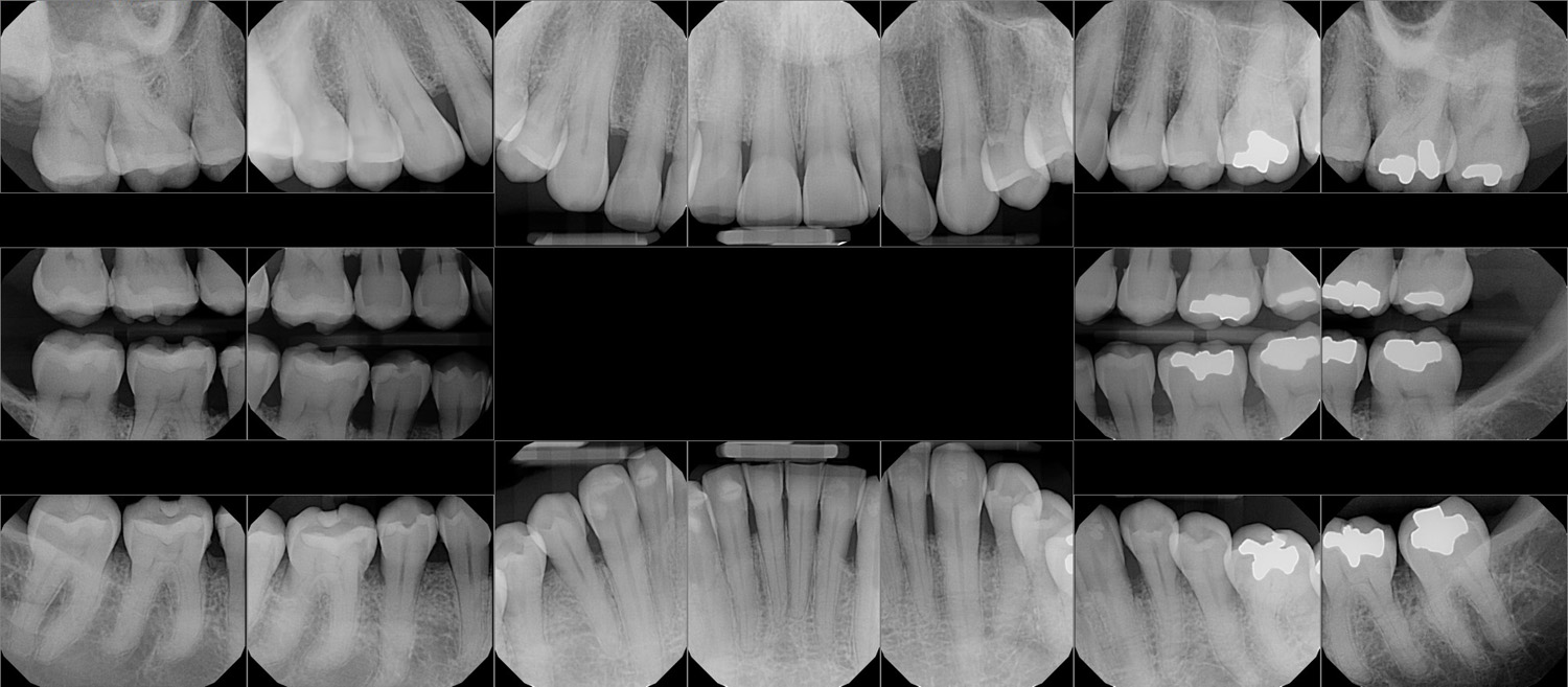 ☢️ FMX Dental X-ray Guide (Are They Safe?)