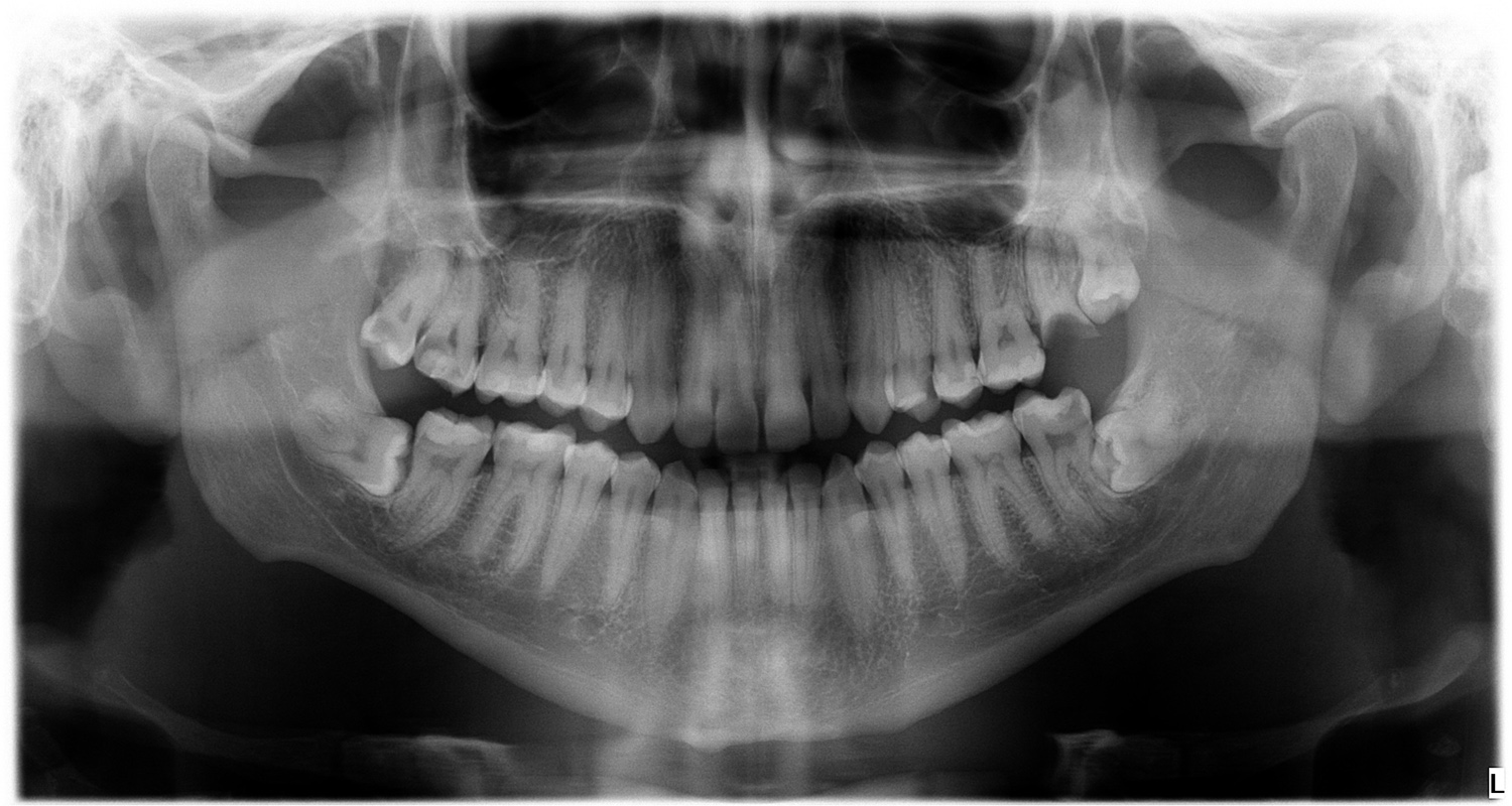 ☢️ FMX Dental X-ray Guide (Are They Safe?)